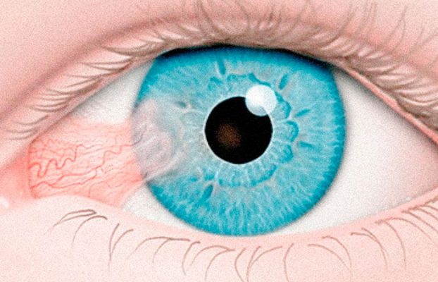 EXÉRESE DE PTERÍGIO COM TRANSPLANTE AUTÓLOGO CONJUNTIVAL