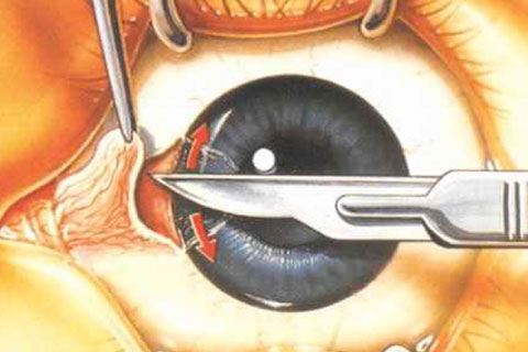 Exérese de Pterígio com Transplante Autólogo Conjuntival